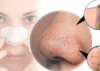 Tuyệt chiêu sạch mụn đầu đen trên da ngay tại nhà hiệu quả