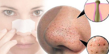 Tuyệt chiêu sạch mụn đầu đen trên da ngay tại nhà hiệu quả