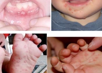 Dấu hiệu bệnh tay chân miệng