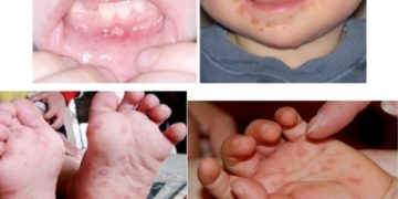 Dấu hiệu bệnh tay chân miệng