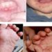 Dấu hiệu bệnh tay chân miệng