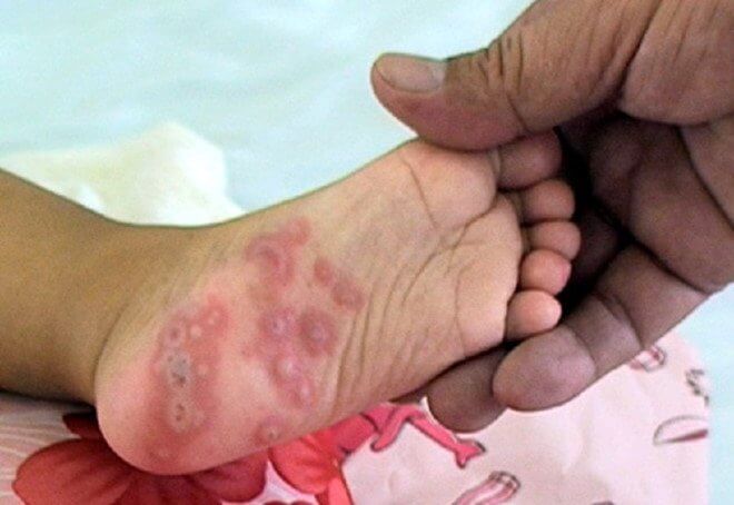 Triệu chứng bệnh tay chân miệng ở trẻ em