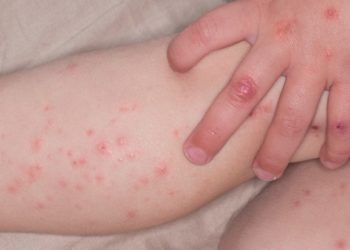 Bệnh tay chân miệng