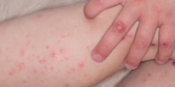 Bệnh tay chân miệng