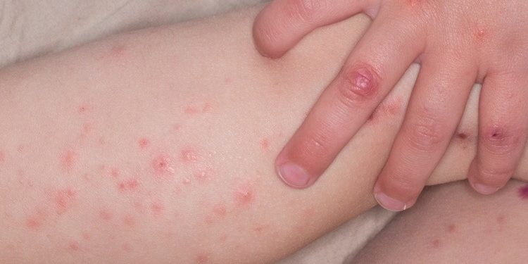 Bệnh tay chân miệng