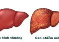 Gan nhiễm mỡ là gì?