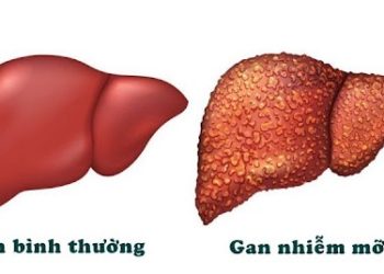Gan nhiễm mỡ là gì?