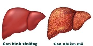 Gan nhiễm mỡ là gì?
