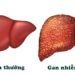 Gan nhiễm mỡ là gì?
