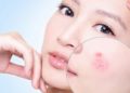 Trị mụn trứng cá