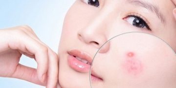 Trị mụn trứng cá