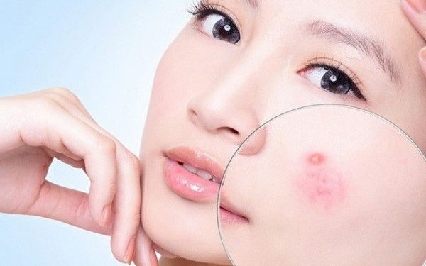 Trị mụn trứng cá
